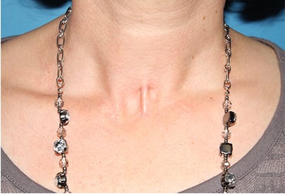 scar revision san antonio