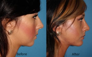 Chin Augmentation Dr. Kenneth Yu