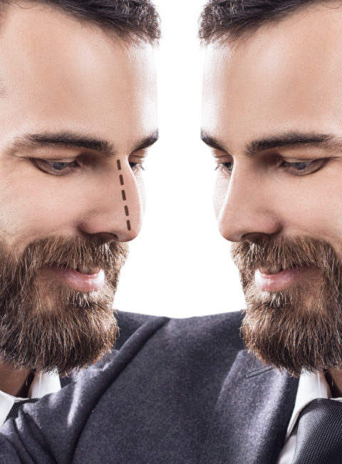 Rhinoplasty for men